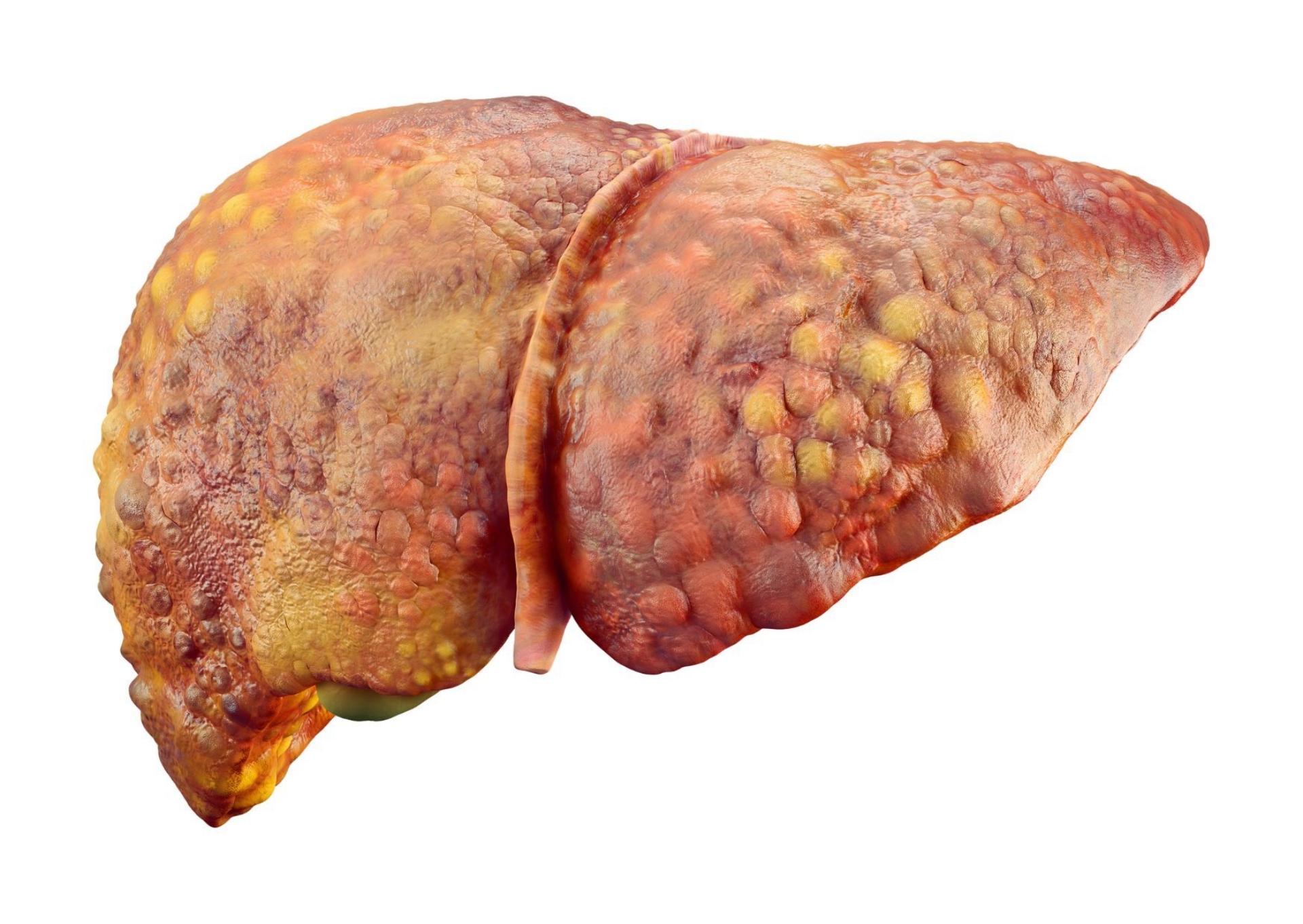 Fatty Liver